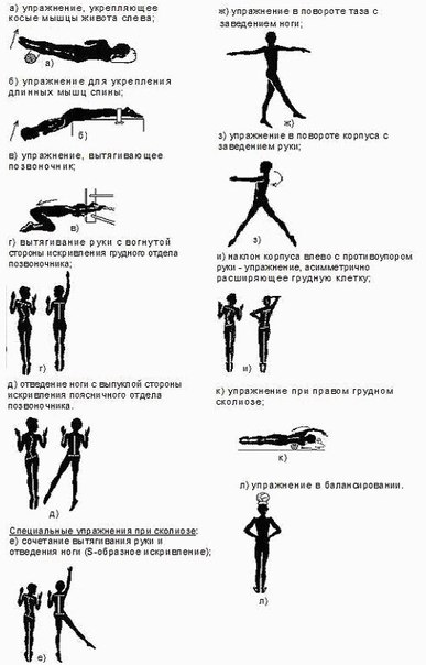 Файл:Scoliose Kaptelin.jpg