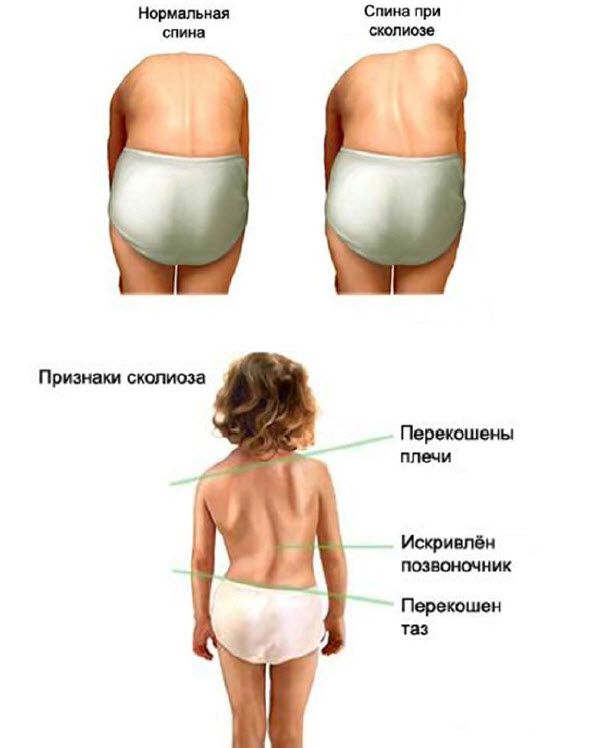 Файл:Scoliose ava 1.jpg