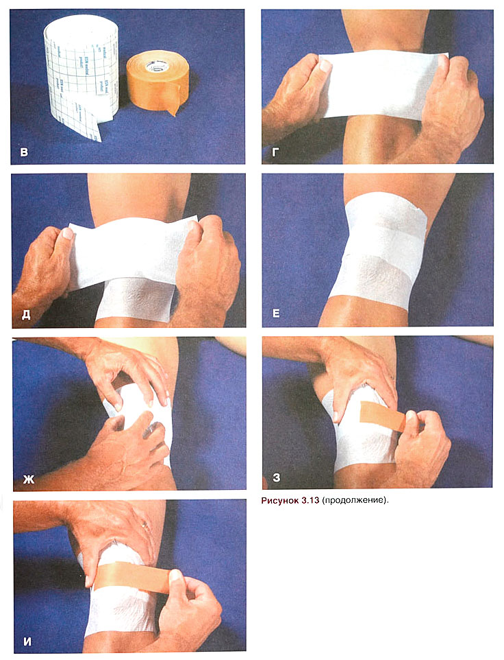 Схема бинтования колена эластичным бинтом