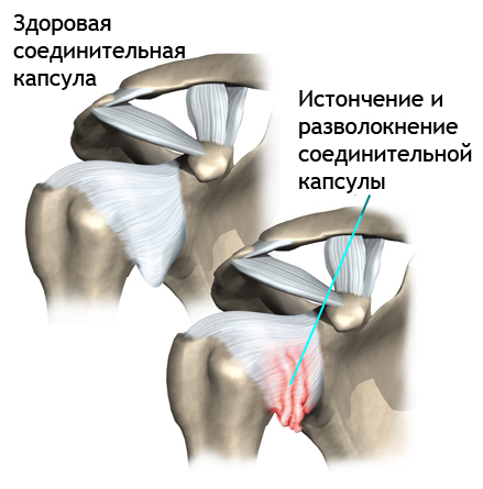 Файл:Humeroscapular.jpg
