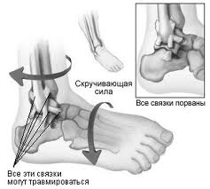 Растяжение связок ноги: статьи клиники Оксфорд Медикал Киев