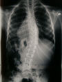 Scoliosis x-rays.JPG