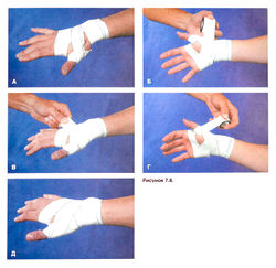 Лечение растяжения связок на руке