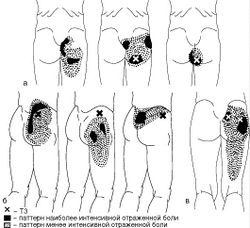 Рис. 12. Локализация Т3 и паттерн отраженной боли при МФБС а) большой ягодичной; б) средней ягодичной; в) грушевидной мышцы