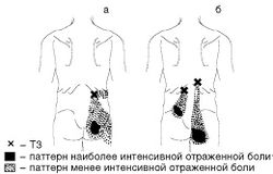 Рис. 8. Локализация ТЗ и паттерн отраженной боли при МФБС подвздошнореберной (а) и длиннейшей мышцы спины (б)