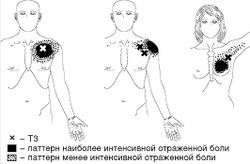 Рис. 7. Локализация Т3 и паттерн отраженной боли при МФБС большой грудной мышцы