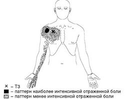 Рис. 3. Локализация Т3 и паттерн отраженной боли при МФБС малой грудной мышцы