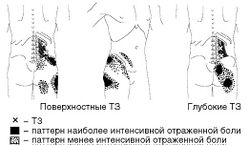 Рис. 10. Локализация Т3 и паттерн отраженной боли при МФБС квадратной мышцы поясницы